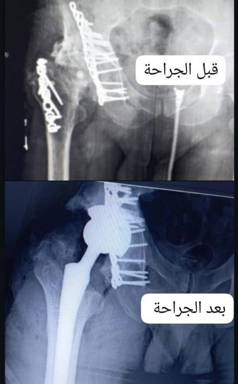 حالة معقدة لتبديل مفصل ورك لاسمنتي شبابي بقلم الدكتور علي عباس الحسون