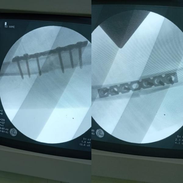 قصة أمل : عندما تعود الحياة لكتف منسي بقلم الدكتور علي عباس الحسون