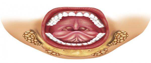 What are the causes of blockage of the salivary glands?