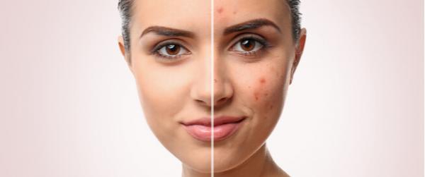 How to treat acne scars