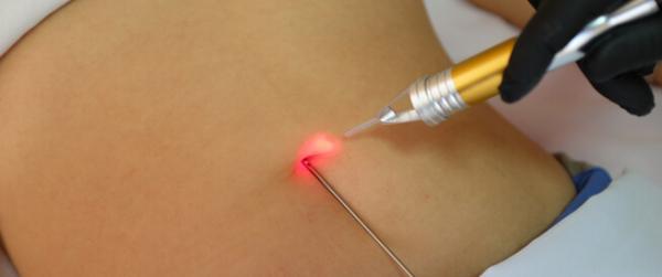 Laser liposuction