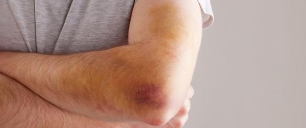 Basic steps to treat bruises