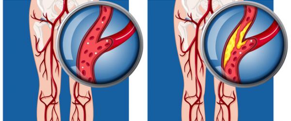 How does a man’s arteries block?